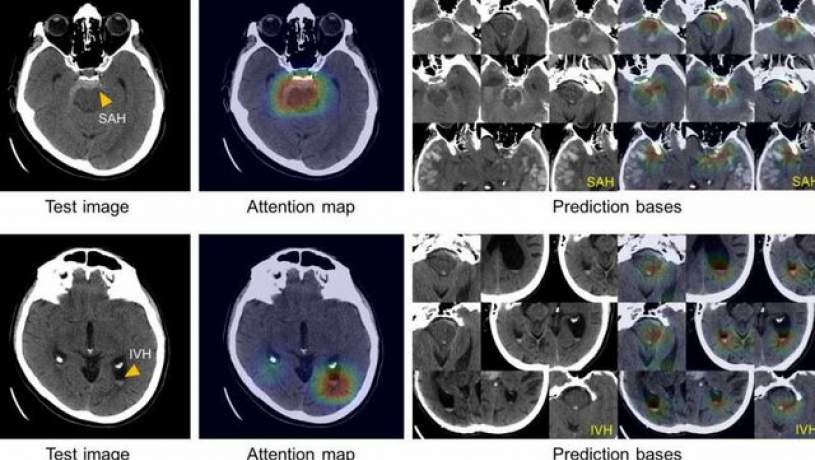 تشخیص خونریزی مغزی با هوش مصنوعی