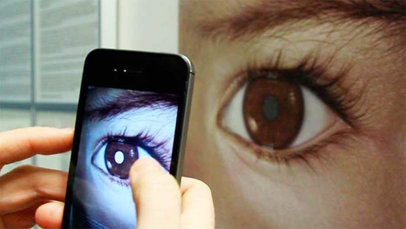 تشخیص سرطان چشم با دوربین آیفون